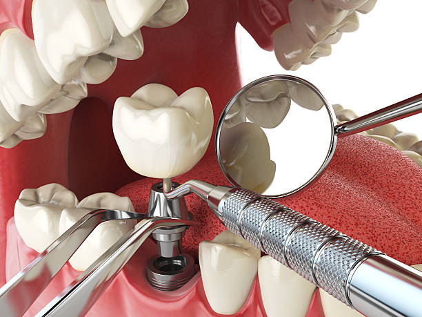 Best Chipped Tooth Repair Near Me  in Burns, OR
